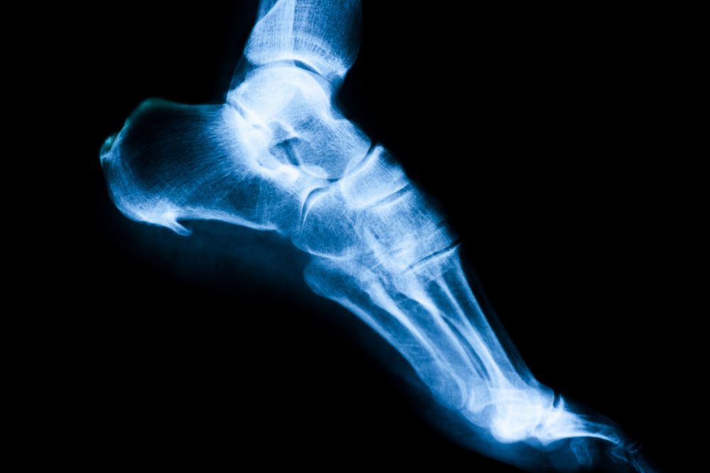 Bone Spurs on Your Foot - What to Do in Scottsdale - Arizona Foot Doctors